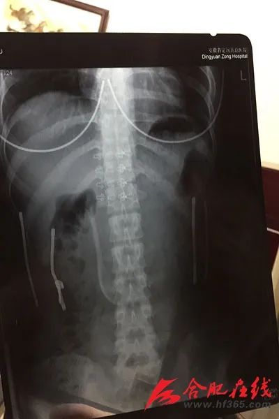 女子误吞17厘米长勺原因,18岁女子误吞17厘米长勺