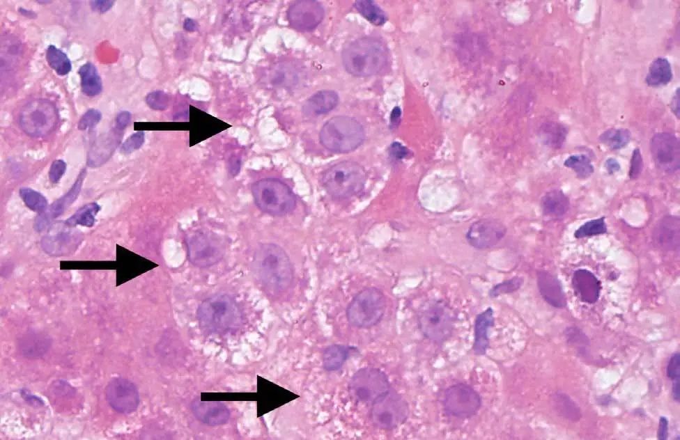 皮肤红疹有小水泡病例,病理性黄疸出现皮疹