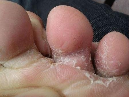 脚臭脱鞋多久可以去味,脱鞋臭脚怎么快速除臭