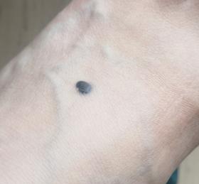 注意|这几天上万网友在身上找痣！知名医生：长在这些地方的特别留意！