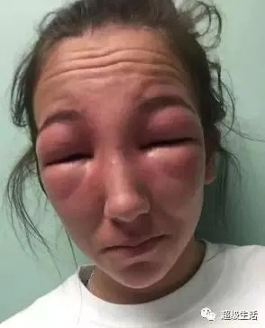 全球十大危险有毒动物,加拿大毒虫名单