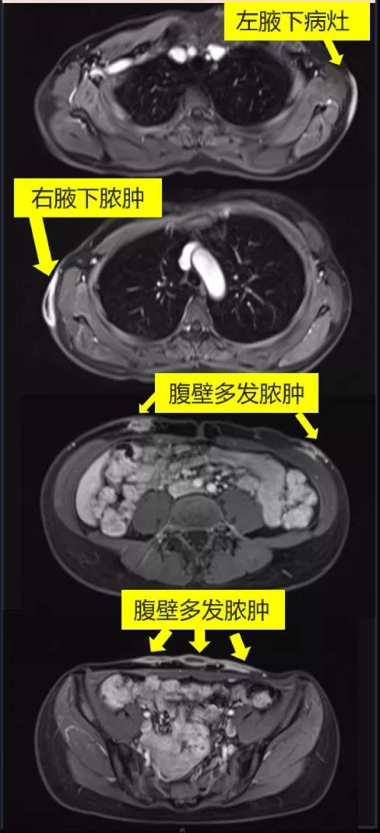 埋线感染严重吗,女子埋线减肥后遗症