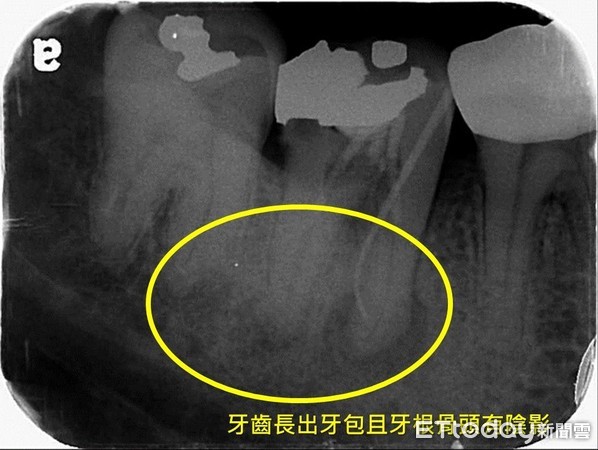 别以为抽过神经就没事？　１名女子牙齿根管细菌滋生而长牙包