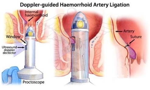 超声多普勒痔动脉结扎术利弊,超声刀治疗痔疮还需要内扎吗