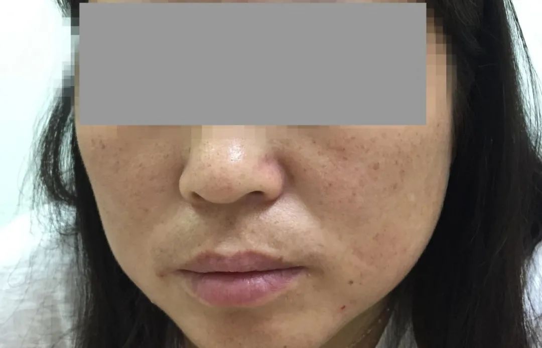 脸上长斑了怎么消除最有效中医,脸上长斑中医怎么治疗效果怎么样