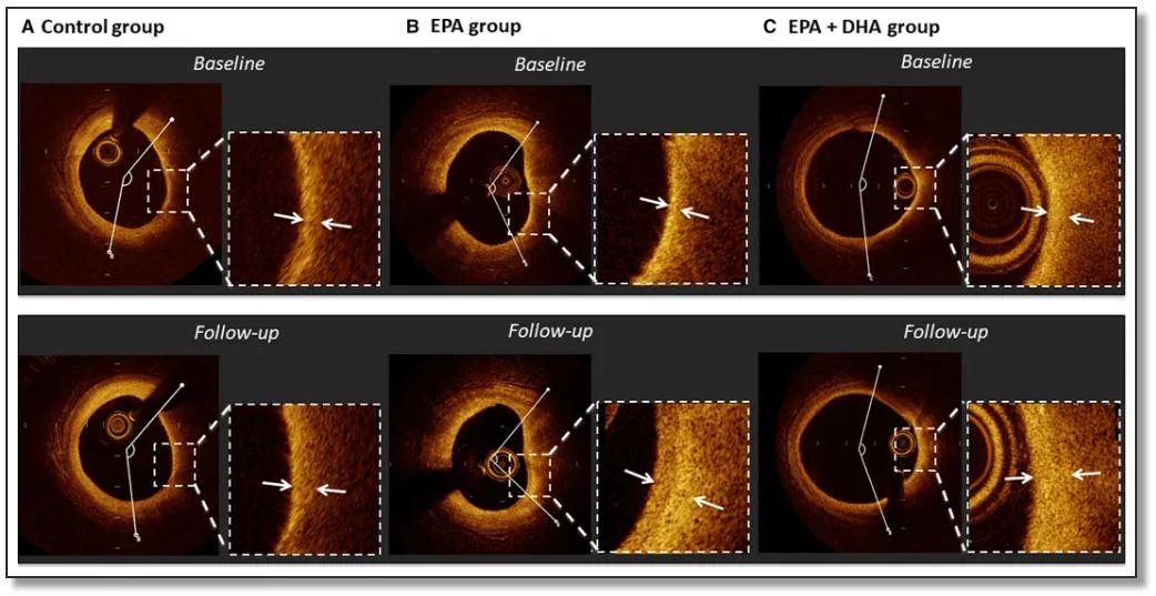 「JAHA」强化他汀+脂肪酸，能否逆转ASC冠脉斑块？