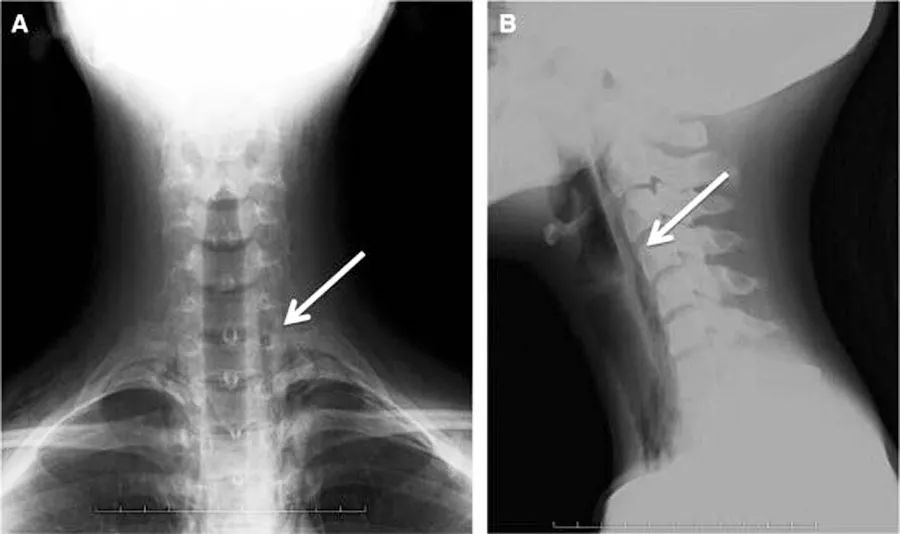咽鼓管有积液能引起头胀头疼吗,咽鼓管堵塞导致鼓室积液