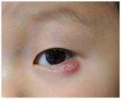 眼皮长了小疙瘩自己掐下来了,眼皮上长了个小肉粒是疣吗