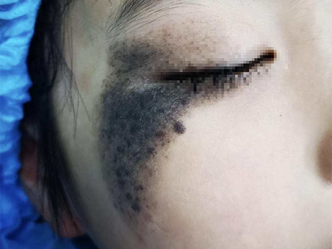【专家在身边】右脸大面积黑斑,还长毛发!2年多的精心治疗,让大眼萌娃有了正常肤色
