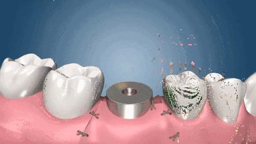 种植牙科普：揭秘种植牙修复全过程，每个步骤都很重要