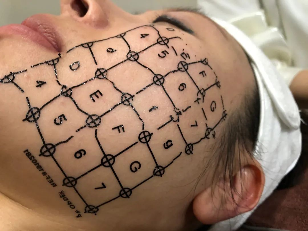 网红热玛吉效果怎么样,成都妹子素颜