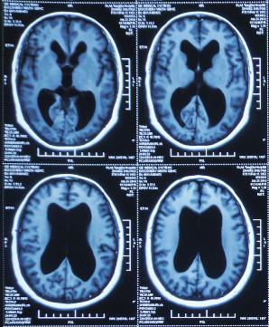 脑积水腹腔分流术后头晕头痛,脑积水分流术后发烧会有什么后果