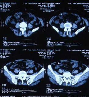 脑积水腹腔分流术后头晕头痛,脑积水分流术后发烧会有什么后果