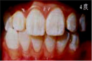 地方病防治宣传核心信息—碘缺乏病、包虫病、地方性氟中毒