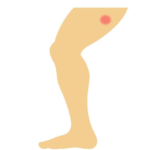 大腿根长个硬包好几天了,大腿根长了个包是怎么回事