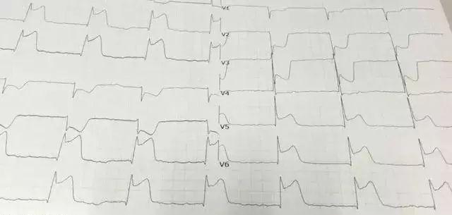 34岁北大博士心梗猝死,国世平老师突发心梗