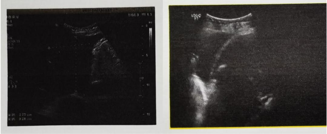 重组人血管内皮抑制素主治啥病,重组人血管内皮抑制素使用图片