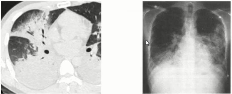 支原体肺炎症状应该注意什么,支原体肺炎这些症状要警惕