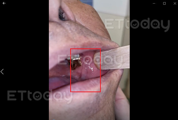 独／「口水涌泉」狂泌10年！他爆：差点被淹死　医首见惊…里面都是