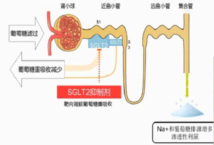 指南解读心衰时利尿剂怎么用,心力衰竭强心利尿药物如何使用