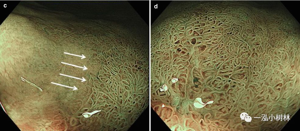 炎症性肠病内镜下表现,炎症性肠病早期筛查结果