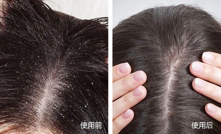 火遍全网的生发养发防脱固发,去屑止痒防脱养发