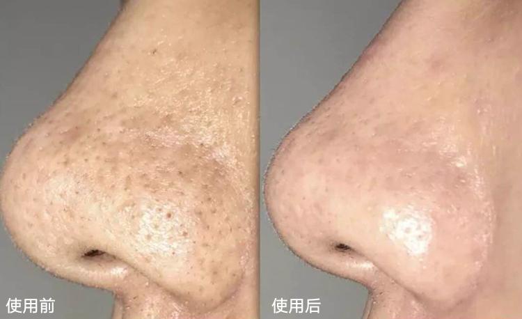 痘痘挤出的白米粒是什么,痘痘挤出来的白色乳浆是什么