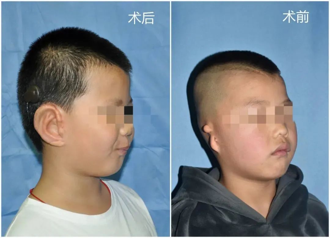 小耳畸形患者救助项目,小耳畸形援助最新消息