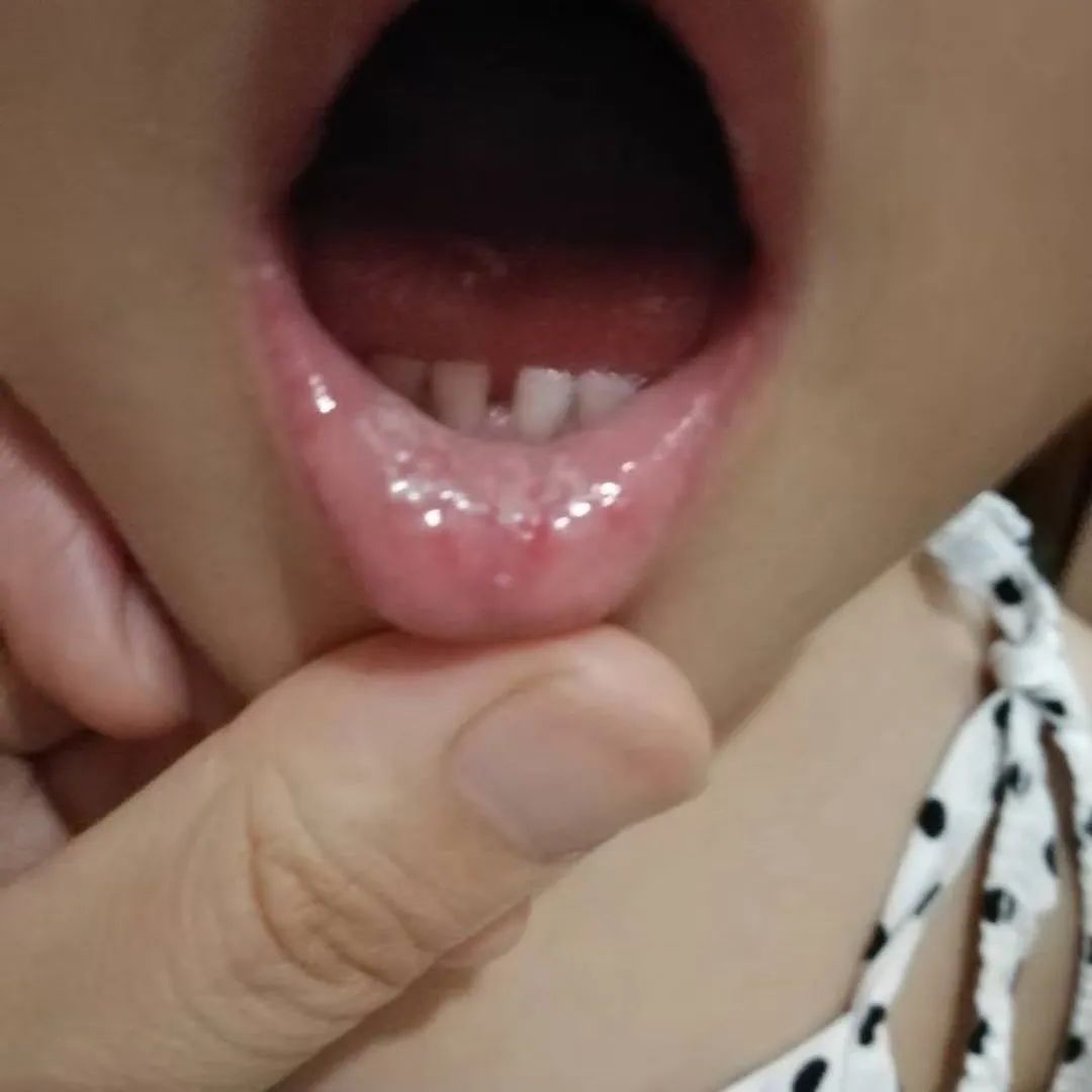 宝宝嘴里长了鹅口疮好不了怎么办,友谊口腔科普
