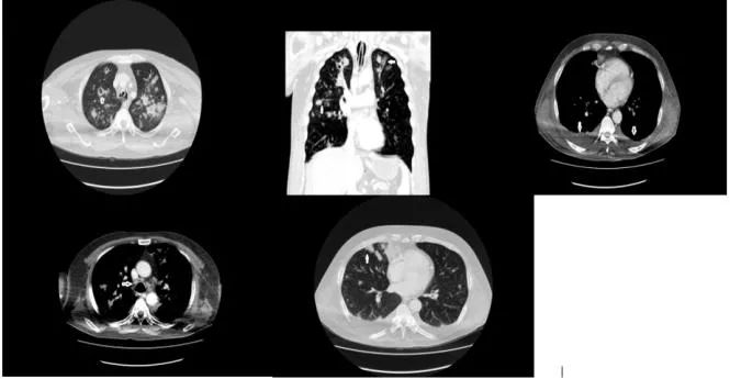 细菌性肺脓肿的主要感染途径,细菌性肺栓塞