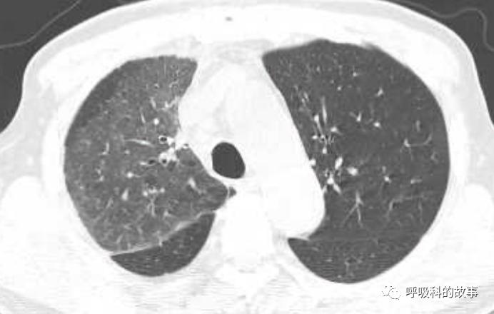 我是如何诊治肺炎的？（4）——如何理解抓住关键信息（2）