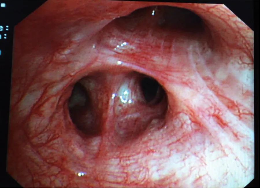 粟粒状肺结核肺部ct表现,粟粒型肺结核ct图