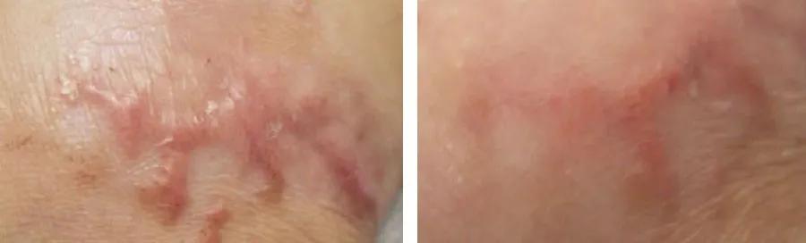 贴上就能消除疤痕是真的吗,脸上有疤如何淡化疤痕