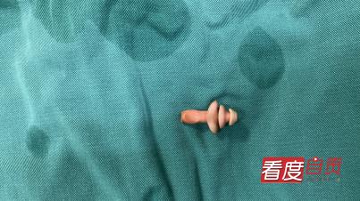 10岁女童身上有异物,小儿吞异物一周未排出