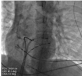 航天中心医院射频消融,航天中心医院介入手术