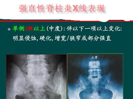 35岁男性患有强直性脊柱炎,老人腰直不起来是强直性脊柱炎