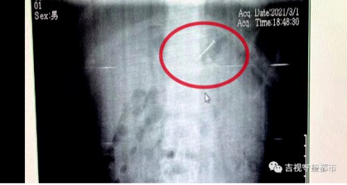 误吞4厘米钢钉，13岁“熊孩子”被紧急送医