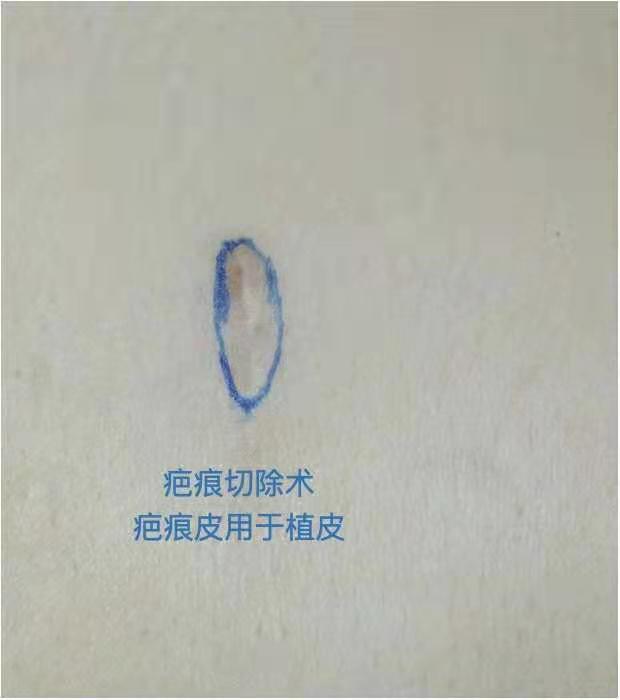 隆鼻鼻尖显形露鼻孔怎么修复,隆鼻修复微驼峰