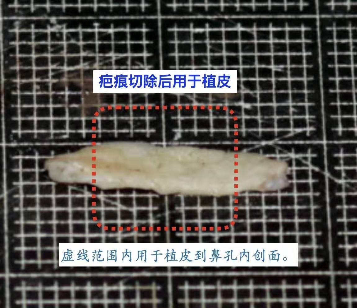 隆鼻鼻尖显形露鼻孔怎么修复,隆鼻修复微驼峰