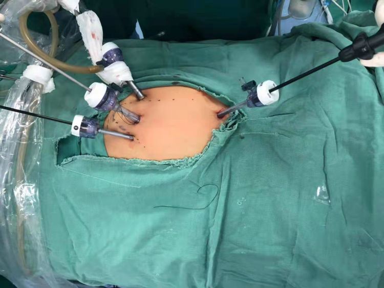 腹腔脏器修补术有哪些,腹腔探查手术戳孔位置