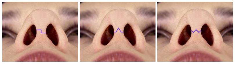 鼻综合整形切口,鼻综合切口处愈合几率