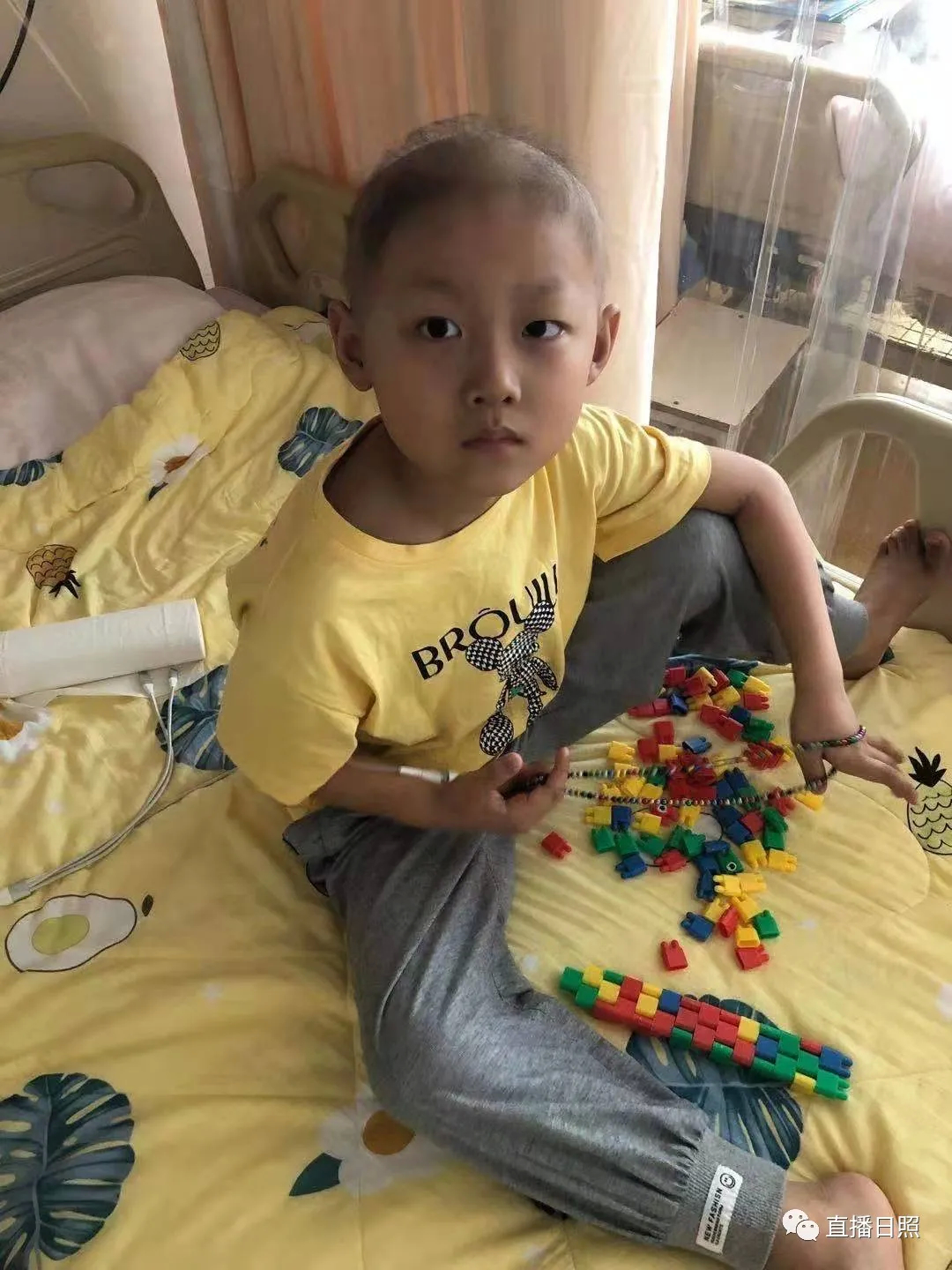 5岁男孩腿上老是有青一块紫一块,5岁男孩小腿出现圆点淤青