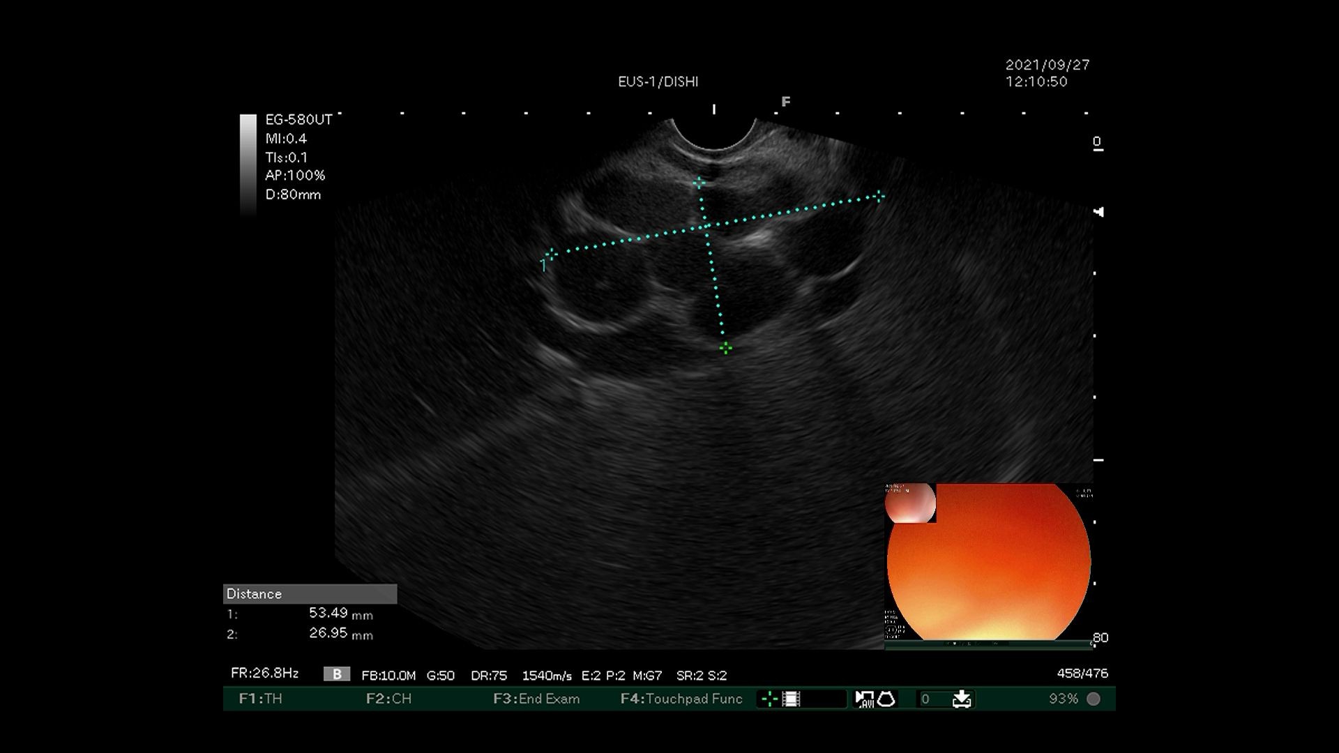 毓璜顶医院国内领先开展超声内镜引导下弹簧圈置入联合组织胶栓塞术治疗伴自发分流的巨大胃底静脉曲张