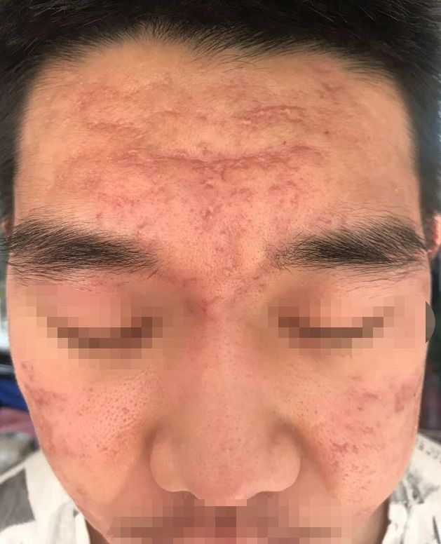 屏障受损起闭口粉刺多长时间能好,不要小看了闭口粉刺