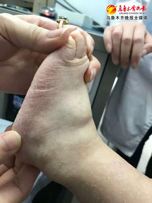 小孩子身上长蛇皮癣,两岁男孩身上长癣