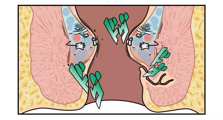 长痔疮怎么办最快的止痔方法,有痔青年怎么治