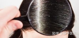 头皮除螨虫的正确方法,头皮上有螨虫用什么方法解决