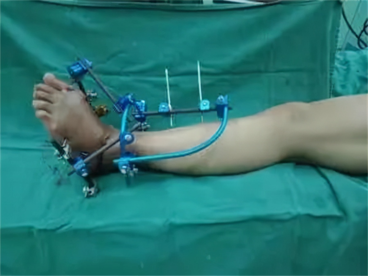 *安泰**市中心医院肢体重建外科运用3D打印技术精准矫治复杂性足踝畸形