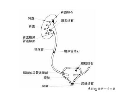 得了输尿管结石怎么治,左输尿管末端小结石怎么治