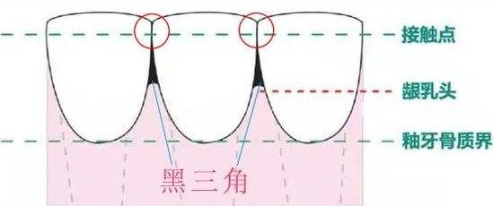 为什么牙齿黑三角不可逆,黑三角是不可逆的吗